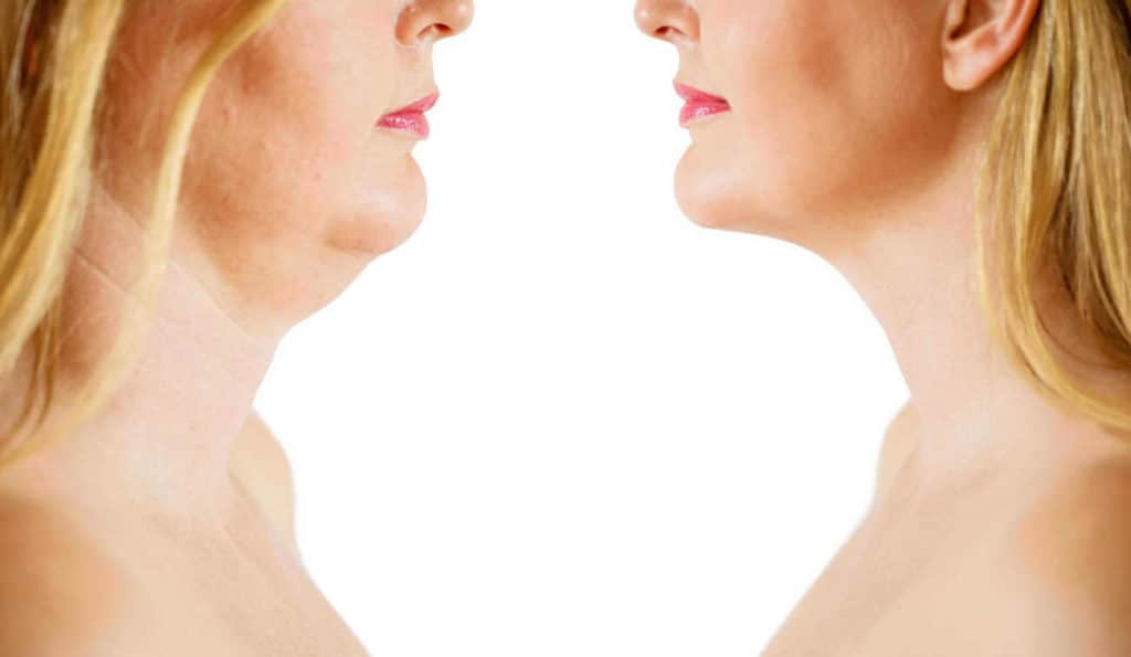 Double Chin treatment Braintree before and after results