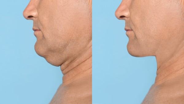 Which Non-Surgical Treatments Work Best for Jowls and Loose Skin Braintree?