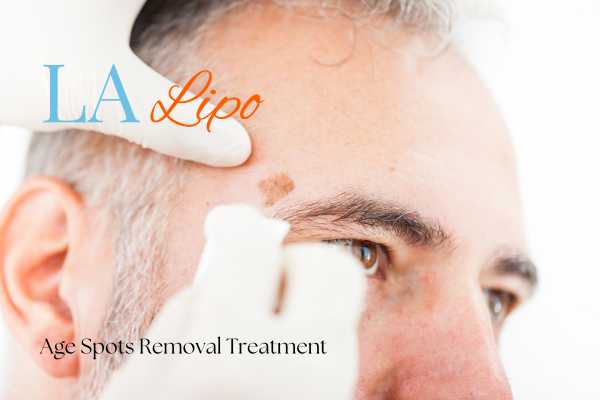 What Are the Most Effective Treatments for Age Spots Braintree?
