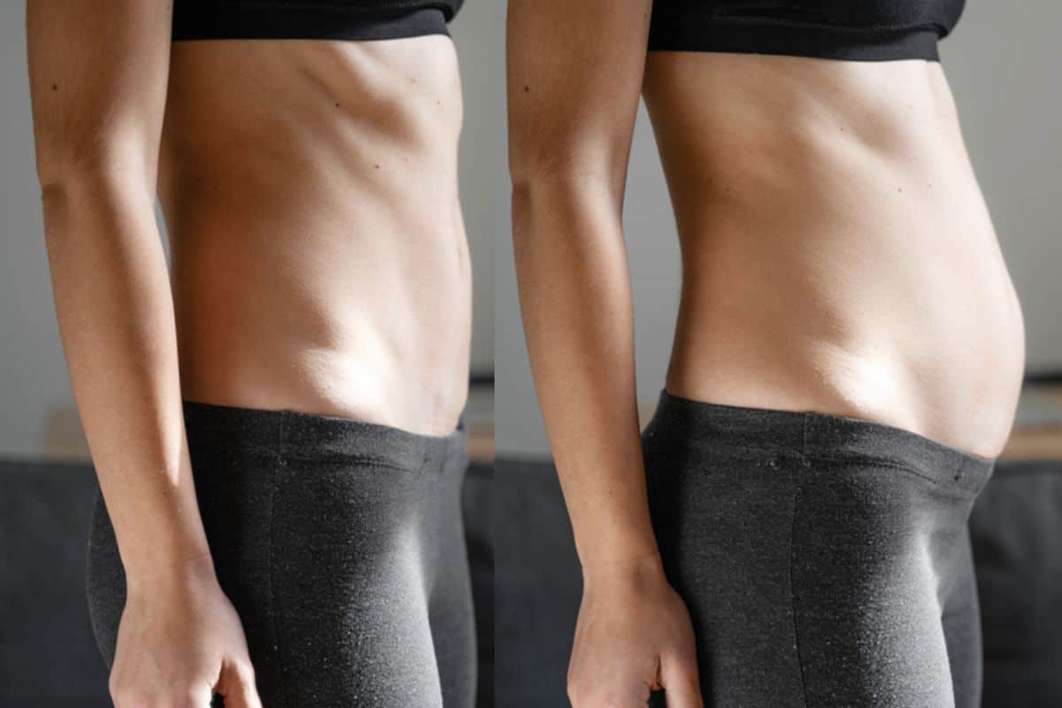 How long does diastasis recti take to improve Braintree?