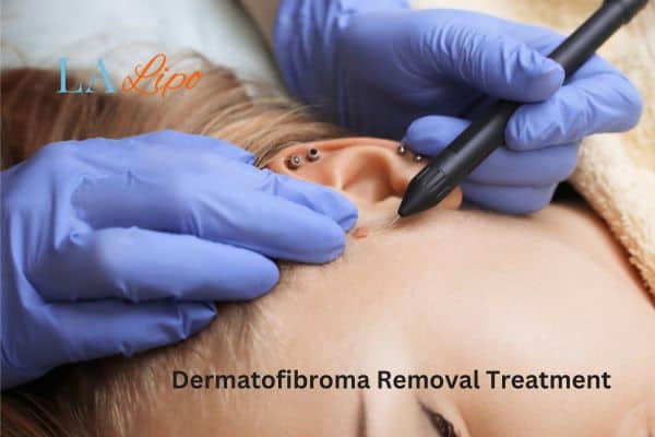 Dermatofibroma Removal Treatment Braintree