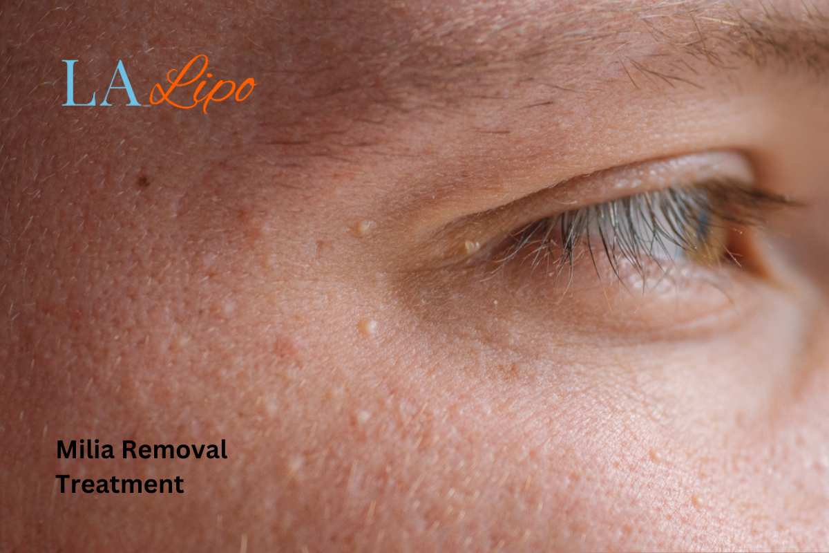 Cryopen Milia Removal: Is It the Easiest and Safest Option Braintree?