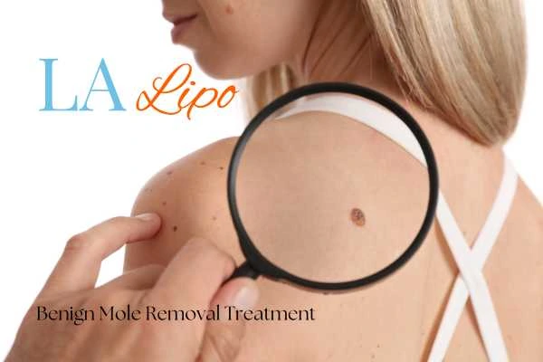 Why getting moles removed Braintree can boost your confidence!