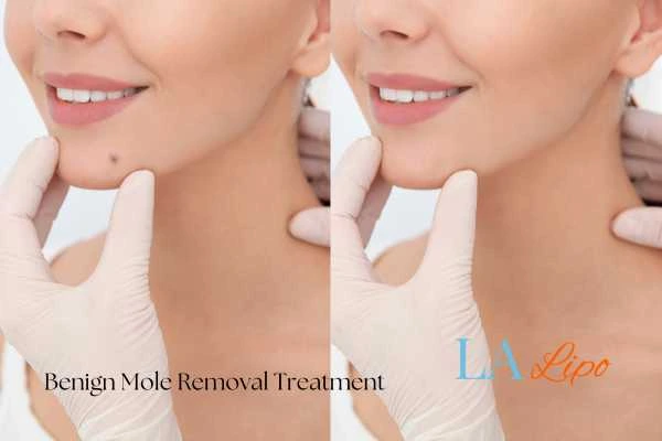 woman's before and after mole removal Braintree results