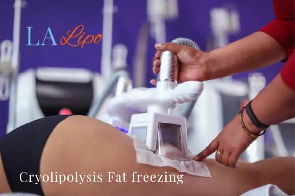 women getting fat freezing Braintree
