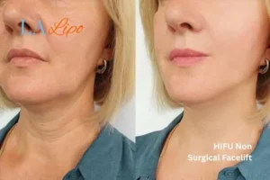 hi-fu for wrinkles Braintree before and after results