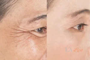 Before and after results of woman - HI-fu wrinkles reduction treatment Braintree