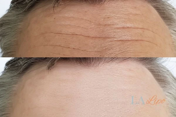 results of HIFU Braintree on mans forehead to help reduce lines and wrinkles
