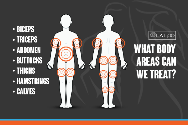 Graphic to show areas you can have LA-EMS Body Sculpting Braintree treatment.