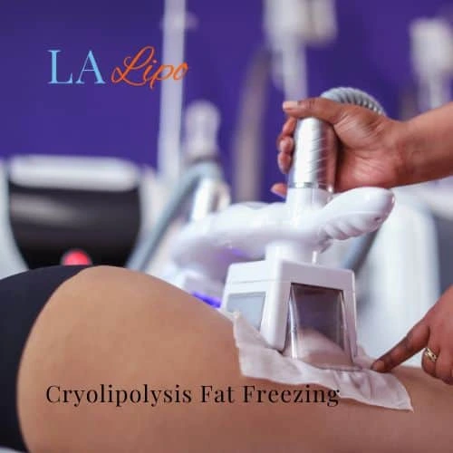 fat freezing - Cryolipolysis Braintree