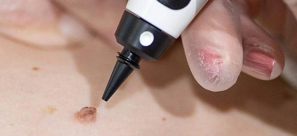 skin tag removal using cryopen Braintree