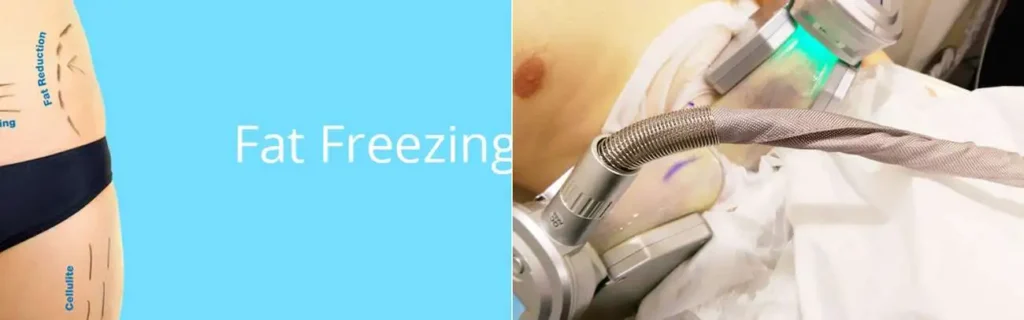 multi areas of a persons body having coolsculpting Braintree treatment