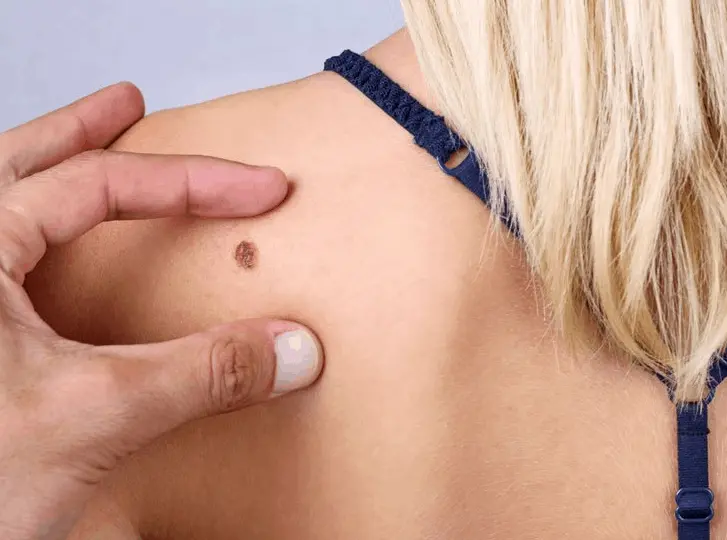 woman having mole removal Braintree consultation before treatment.