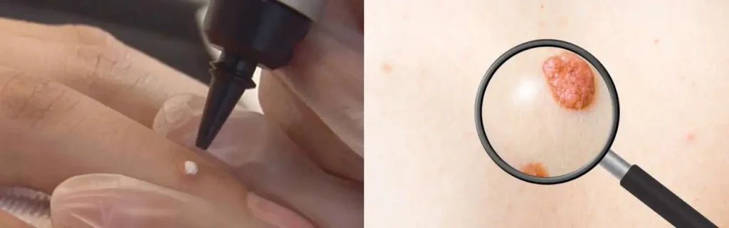 Cryopen for mole removal Braintree - speak to our team today!
