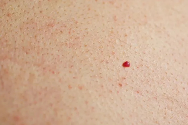 close up of a cherry angioma Braintree