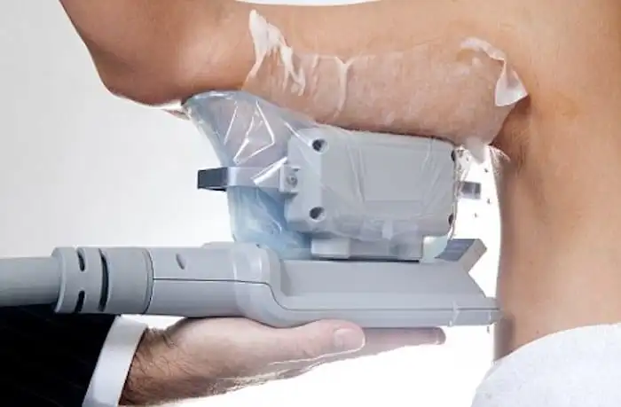 Picture of fat freezing Braintree on the upper arms.