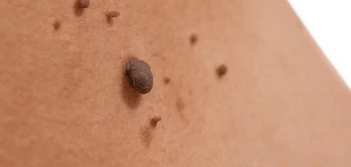 image of a skin tag Braintree