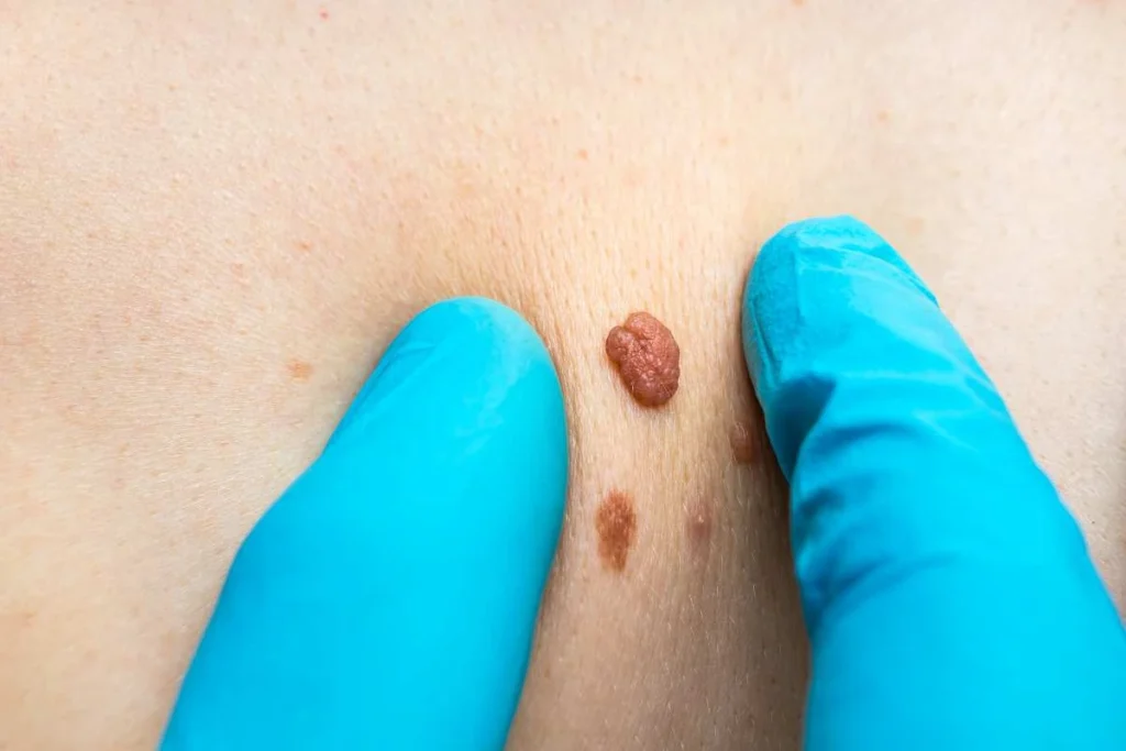Consultant examining a skin tag Braintree
