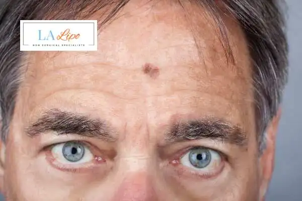 Solar Lentigo Removal Braintree image of man with mark on his forehead