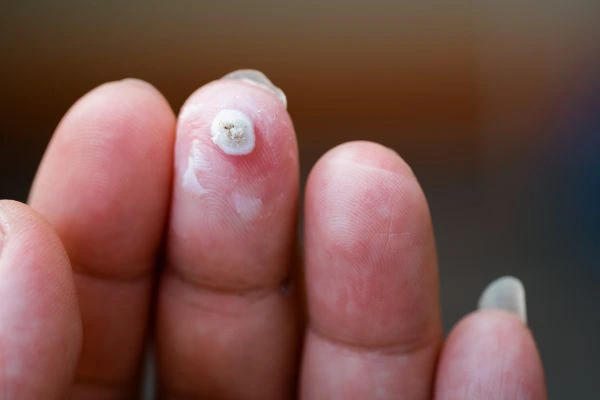 wart on person finger - cryotherapy to treat from LA LIPO Braintree