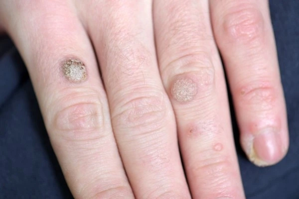 photo of warts on person hand - see wart removal Braintree from LA LIPO