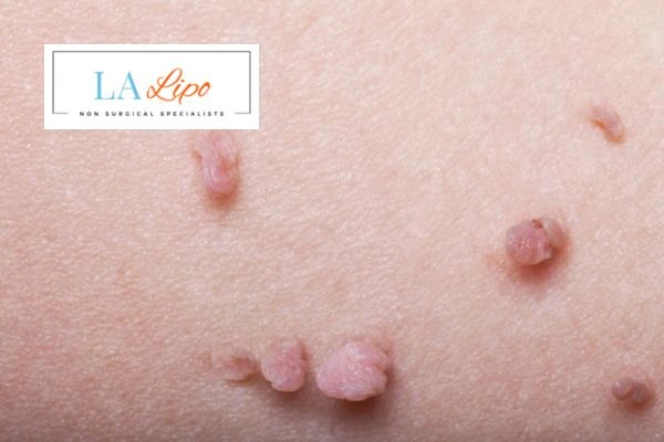 Does cryopen skin tag removal Braintree hurt? Find out now call our team today!