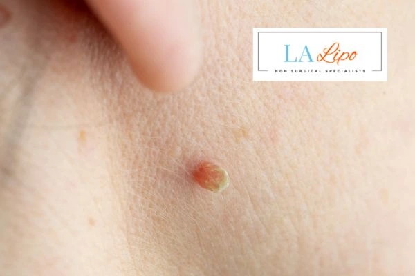 Book skin tag removal Braintree today speak to our team now!