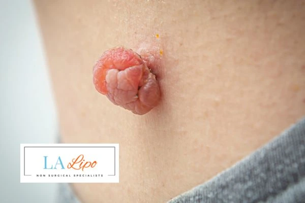 Interested in skin tag removal Braintree? Concerned about the pain? Find out more today!