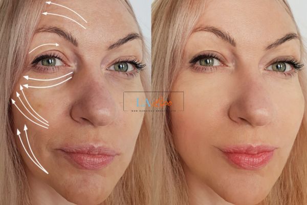 Morpheus 8 results Braintree face lift.