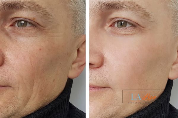 See the amazing results of Morpheus8 Treatment Braintree!