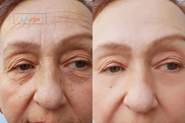 The powerful benefits of Morpheus8 Treatment Braintree - Call Our team today!