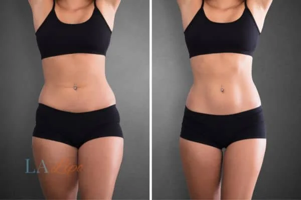 before and after results of non-surgical treatment to help a woman's body image and mental health Braintree