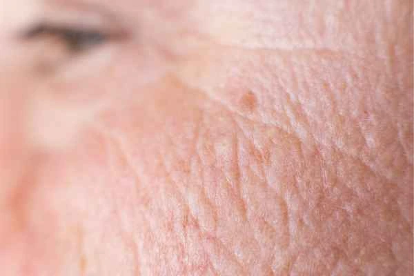 close up picture of a woman's face showing an age spot Braintree