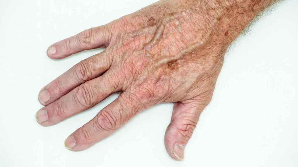 Male hand showing age spot Braintree