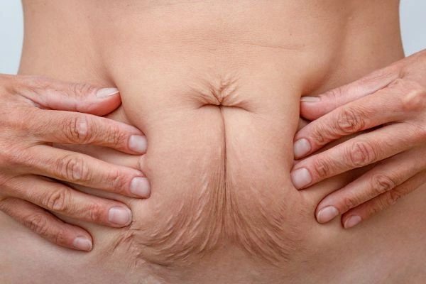 Image of a woman's stomach with loose skin - example of skin tightening Braintree options