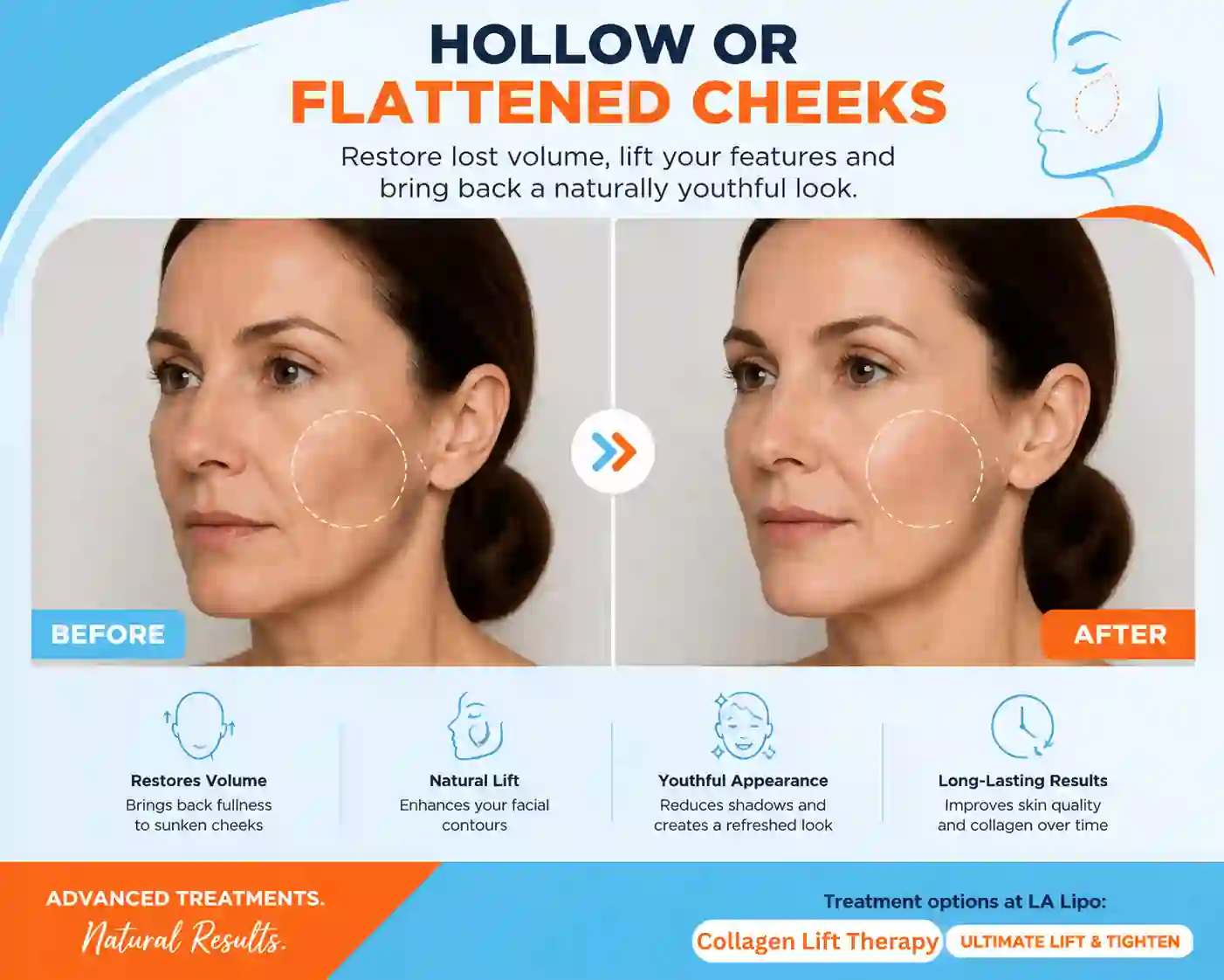 Sign #4: Hollow or Flattened Cheeks Braintree