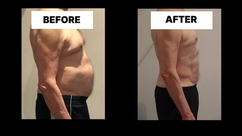 What Symptoms Can Diastasis Recti Cause in Men? Weak Core, Back Pain and Poor Posture Braintree